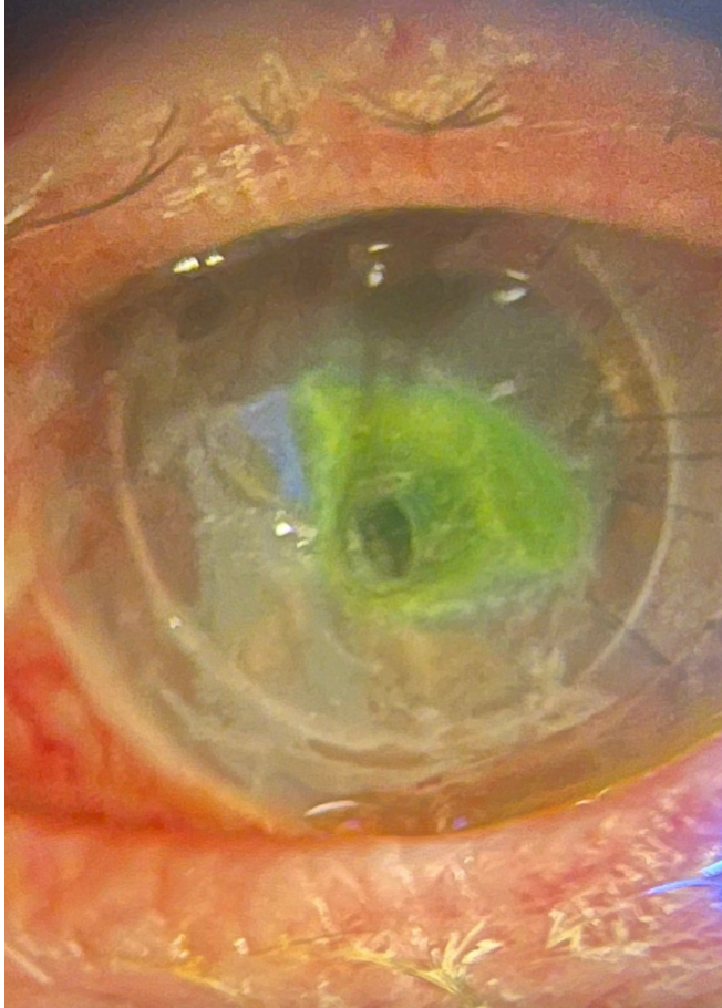 Corneal perforation