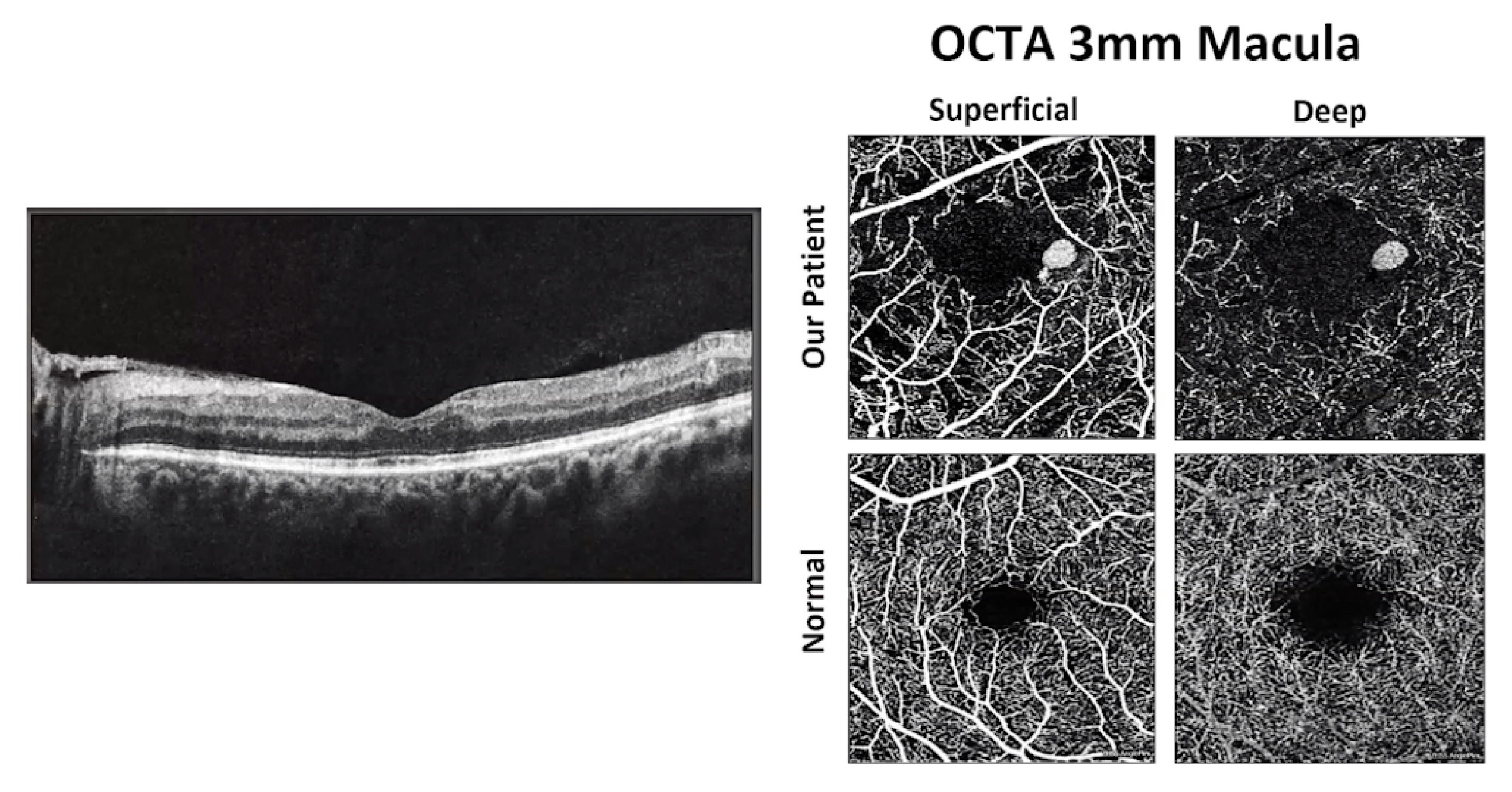 OCT Diabetic Retinopathy