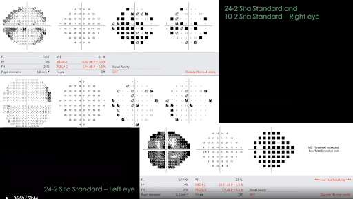 Visual Field Reports