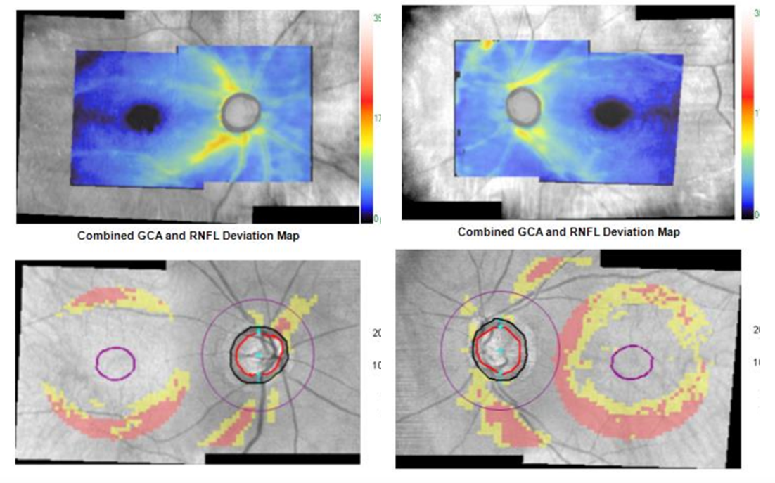 GCA RNFL Deviation