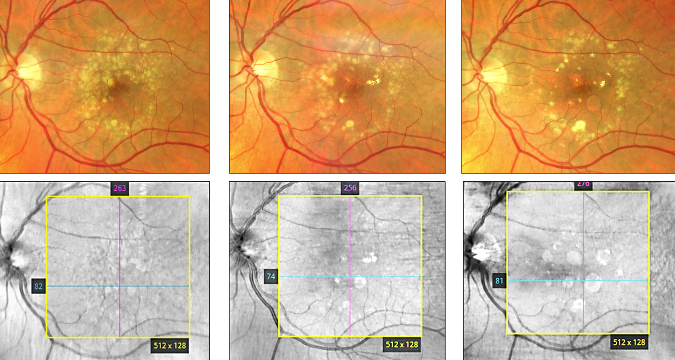 GA NIR imaging