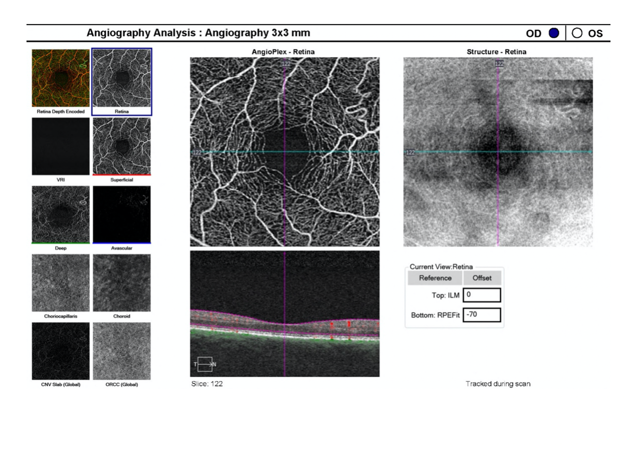 En-Face display showing superficial vasculature disorganization