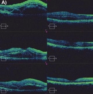 Macula OCT Serous Retinal Detachment Secondary to Preeclampsia