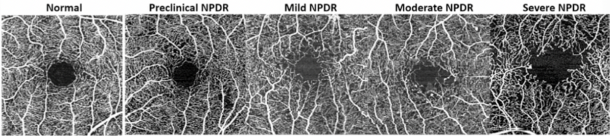 OCTA showing progressive degeneration of the FOV