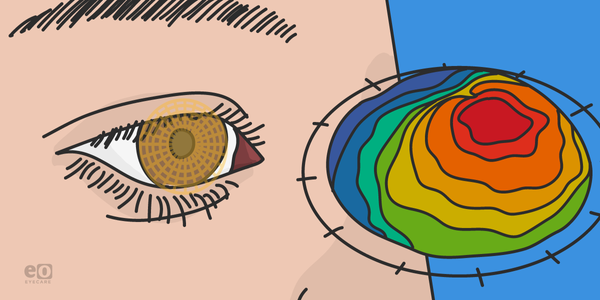 My Clinical Experience with Topography-Guided LASIK