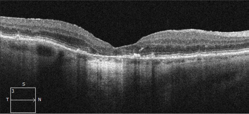 Choroidal hypertransmission OCT