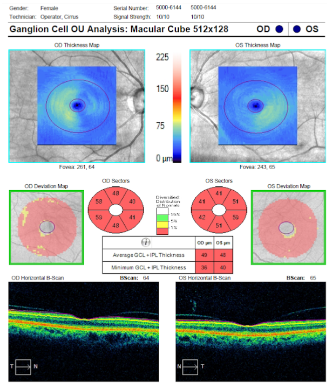 ganglion cell optic disc cube.png