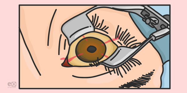 Managing Posterior Capsule Compromise During Cataract Surgery