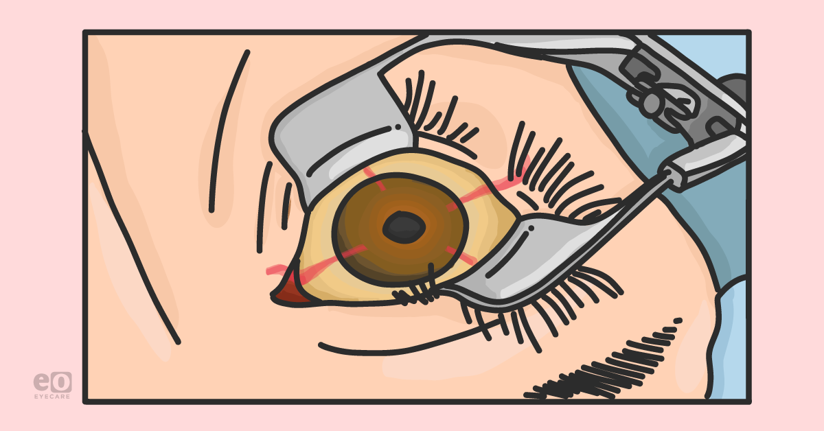 Managing Posterior Capsule Compromise During Cataract Surgery