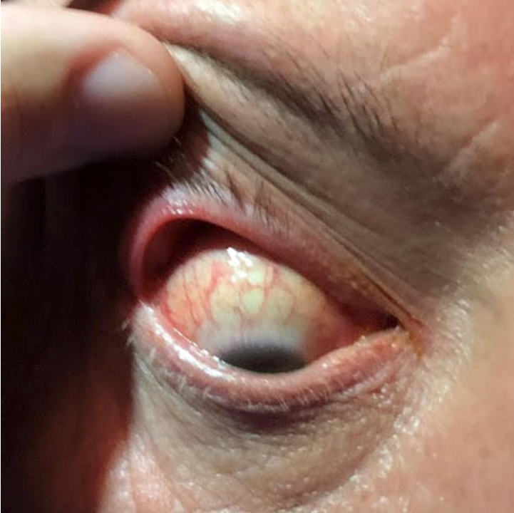 Floppy Eyelid Syndrome