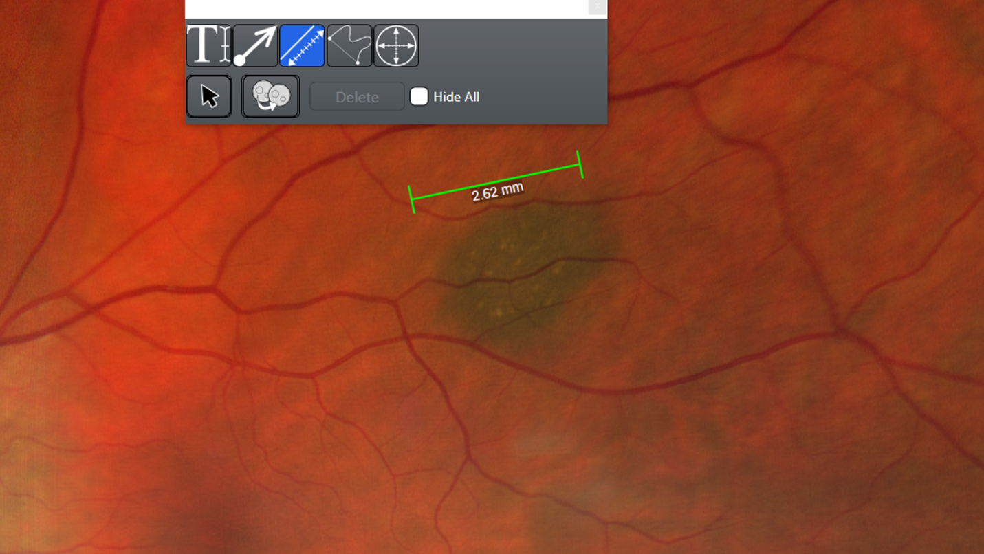 An important variable to determine when examining a lesion is its elevation.