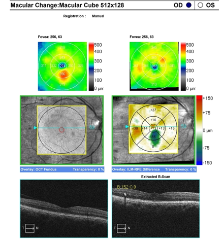 Macular Change