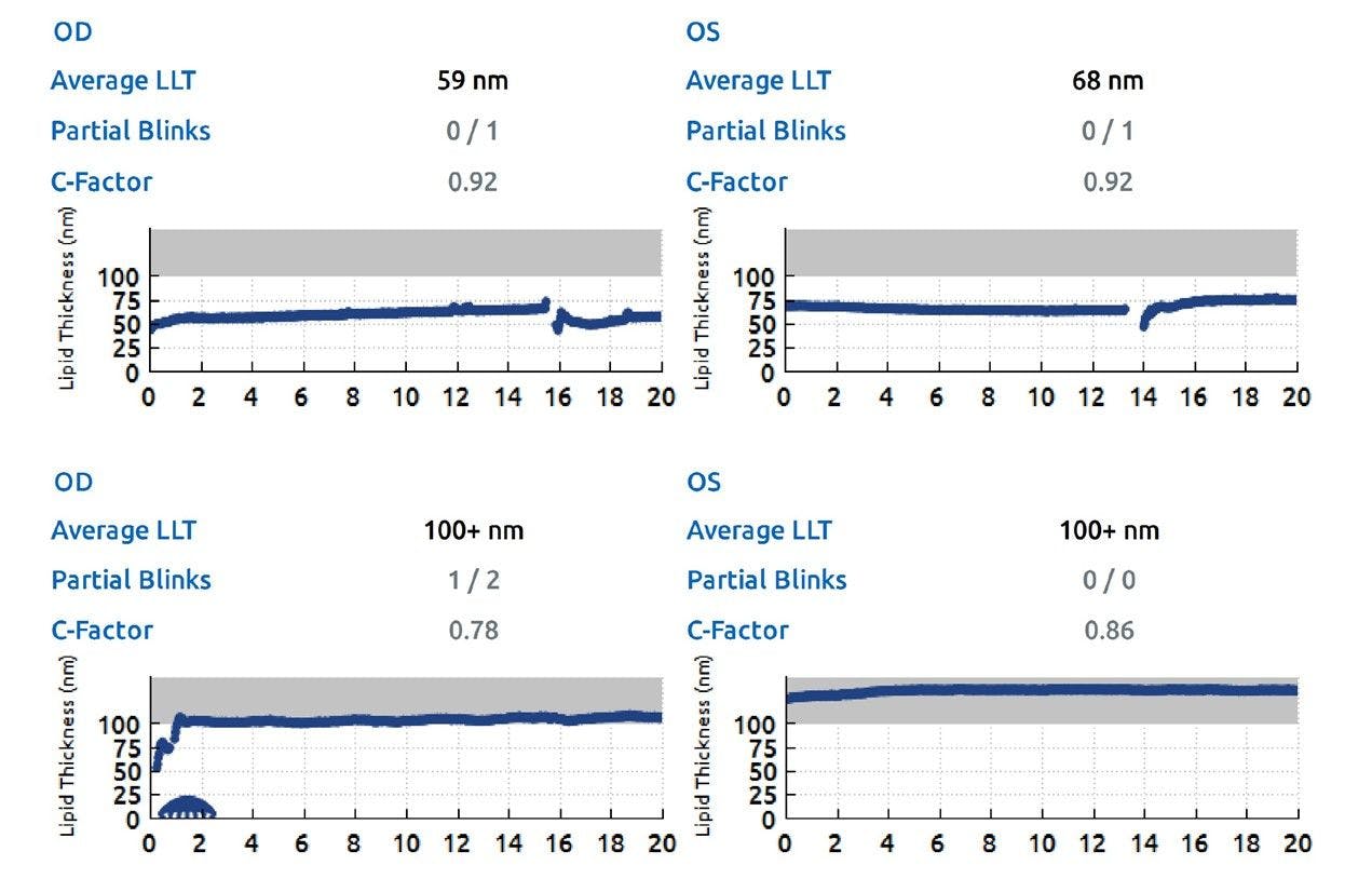 The Psychology of Dry Eye Inread Image 3 LLT