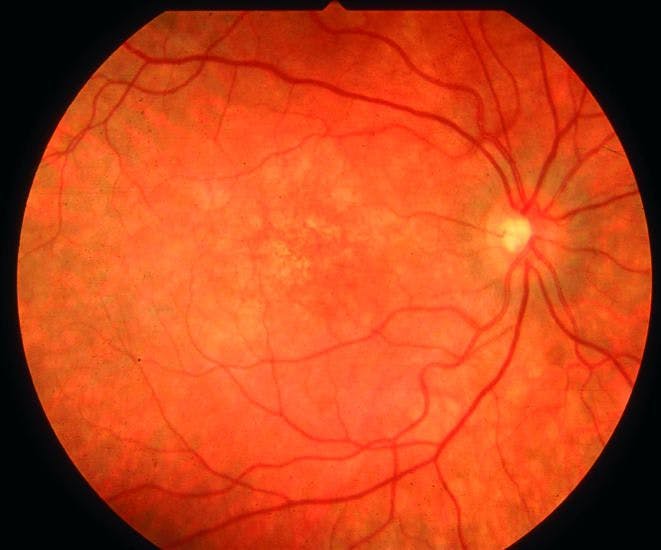 Macular Edema Secondary to Mitotane Usage