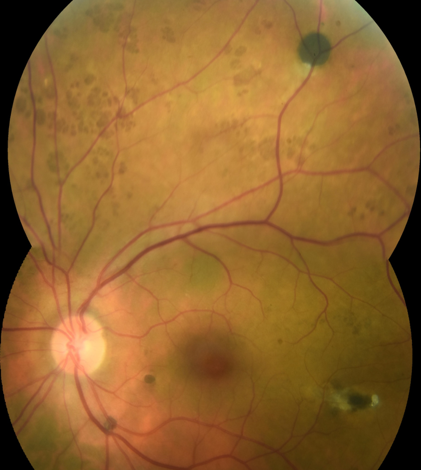 RPE hamartomas associated with familial adenomatous polyposis 2