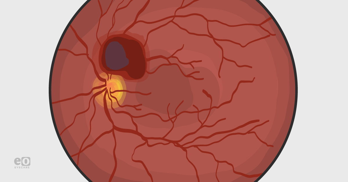 Valsalva Retinopathy: From Diagnosis to Intervention