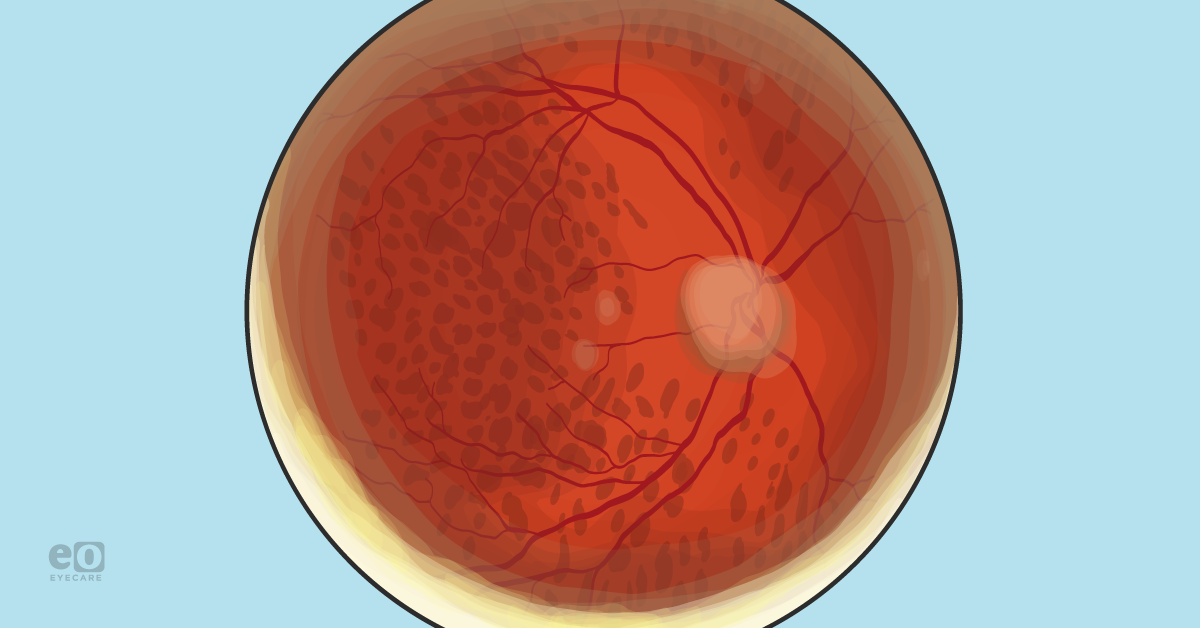 Case Report: Non-Arteritic Anterior Ischemic Optic Neuropathy