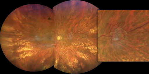 Neovascularization and Hemorrhaging