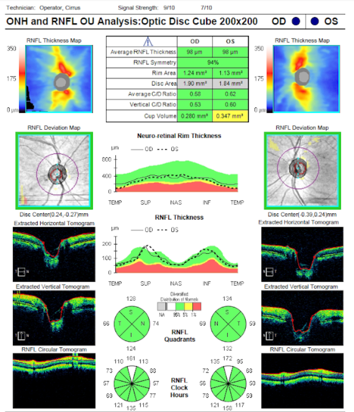 ONH-RNFL OU Analysis 1.png	