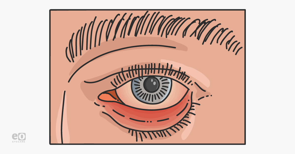 A Clinical Guide to Ectropion