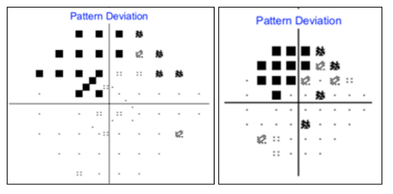 Right Eye SITA Standard Faster Pattern Deviation