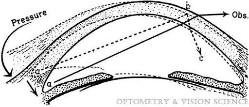 internal-reflection-anterior-chamber-angle.jpg