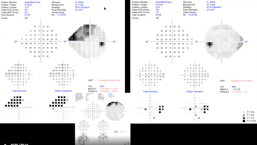 Visual Fields Showing Defect