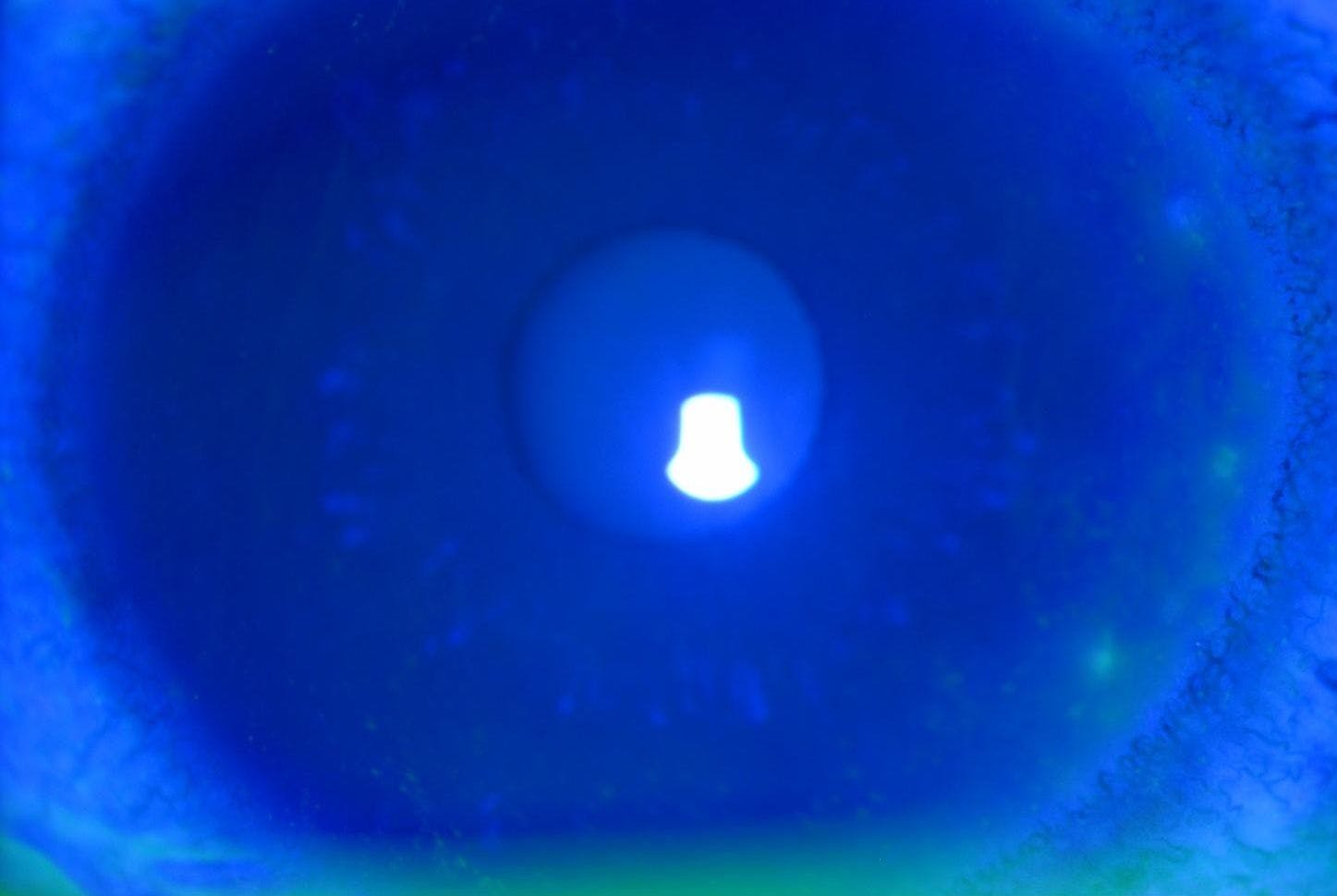 Marginal keratitis sodium fluorescein