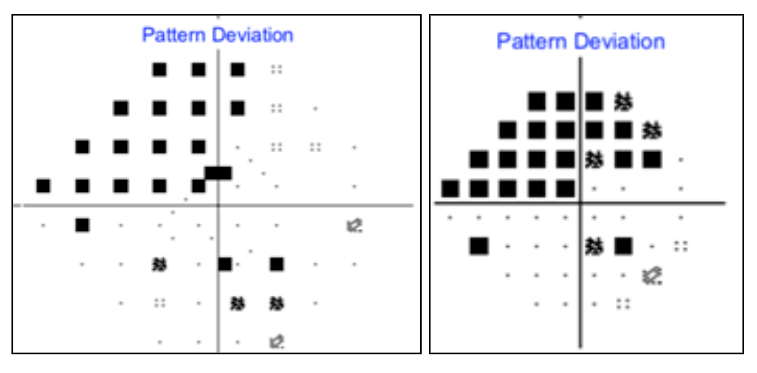 Pattern Deviation Right Eye 24-2C