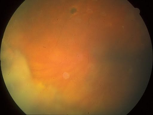 Figure 4: Presentation of pars planitis with vitreous inflammation consisting of snowballs and snowbanking over the pars plana.