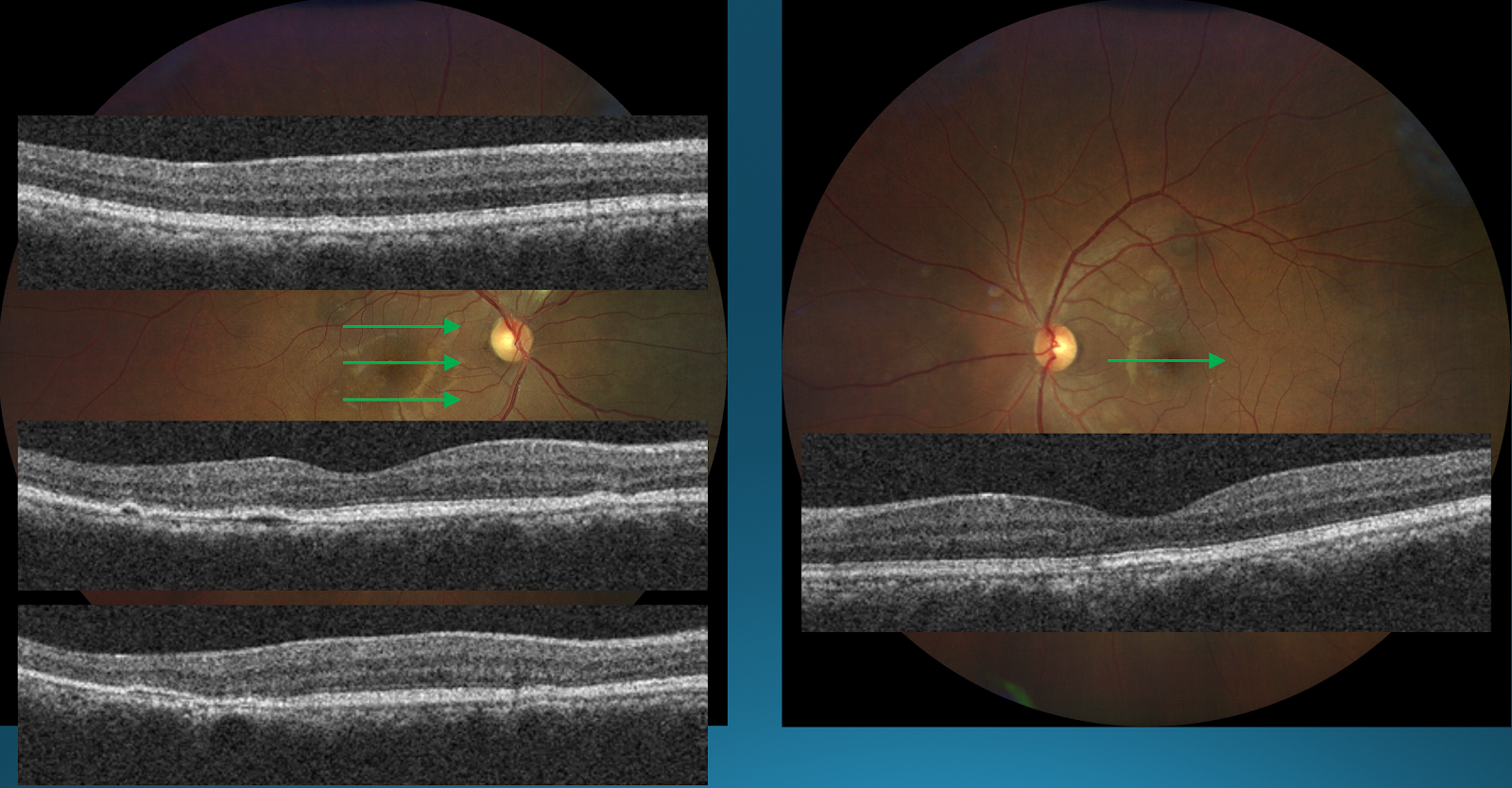 Figure 17: Right Eye (left); Left Eye (right)