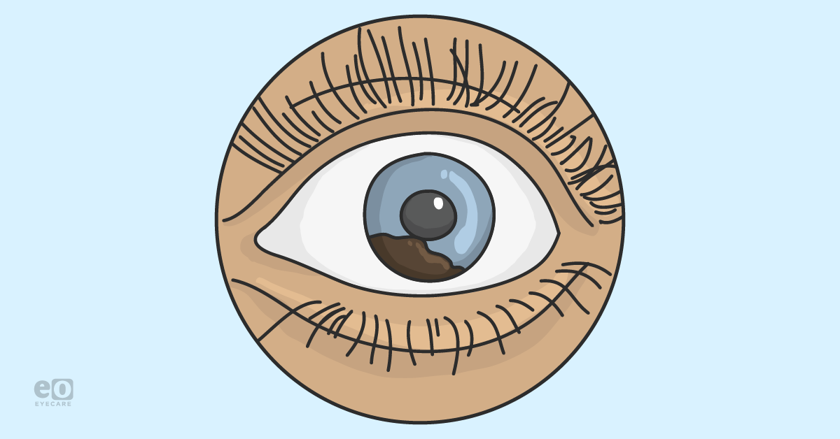 Ophthalmic Metastasis of Breast Cancer: Basics of Diagnosis and Management