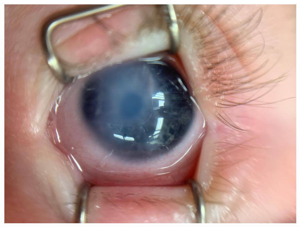 Corneal Edema with PCG