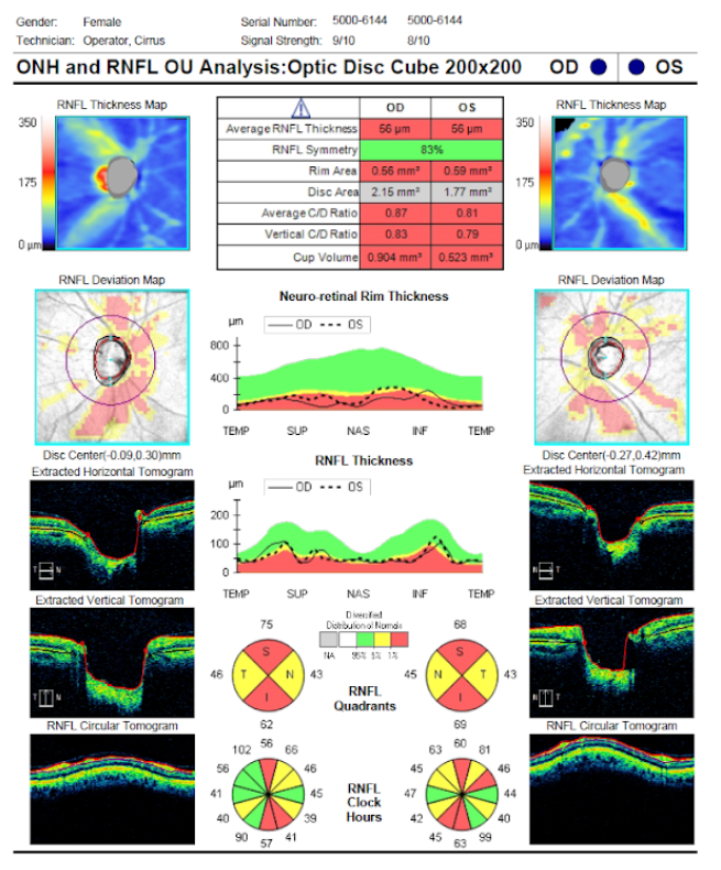 optic disc cube ONH-RNFL.png