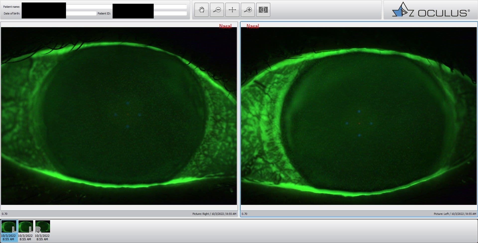 fluorescein staining of diffuse SPK and mild compression rings