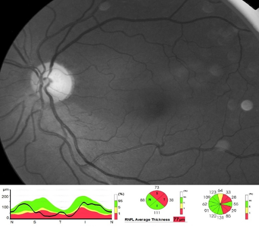 Diffuse RNFL Dropout