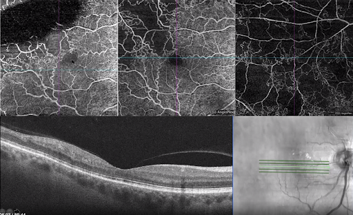 Swelling of the Retina