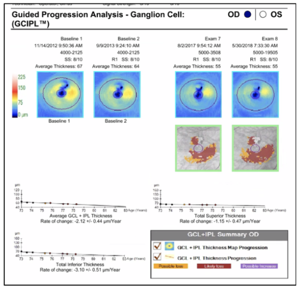 Figure 4. The GCL GPA report for the right eye. Two baseline tests are shown on the left and the two most recent tests are on the right. This report has a similar structure to the RNFL GPA.