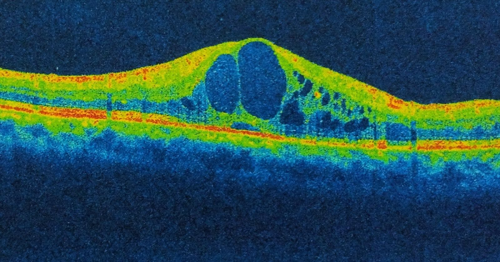 Cystoid Macular Edema