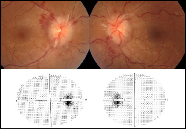 intracranial hypertension