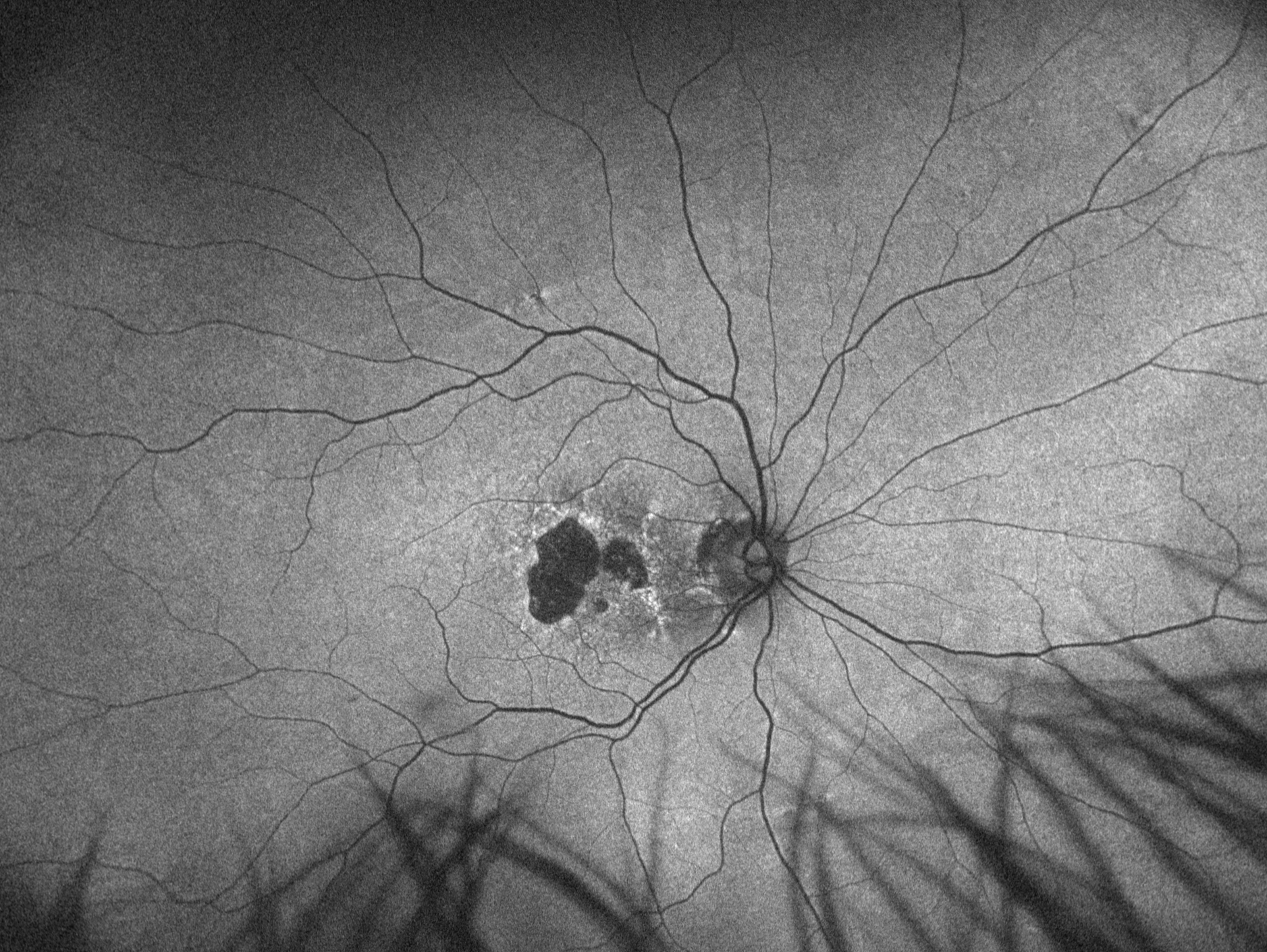 Fundus autofluorescence (FAF)