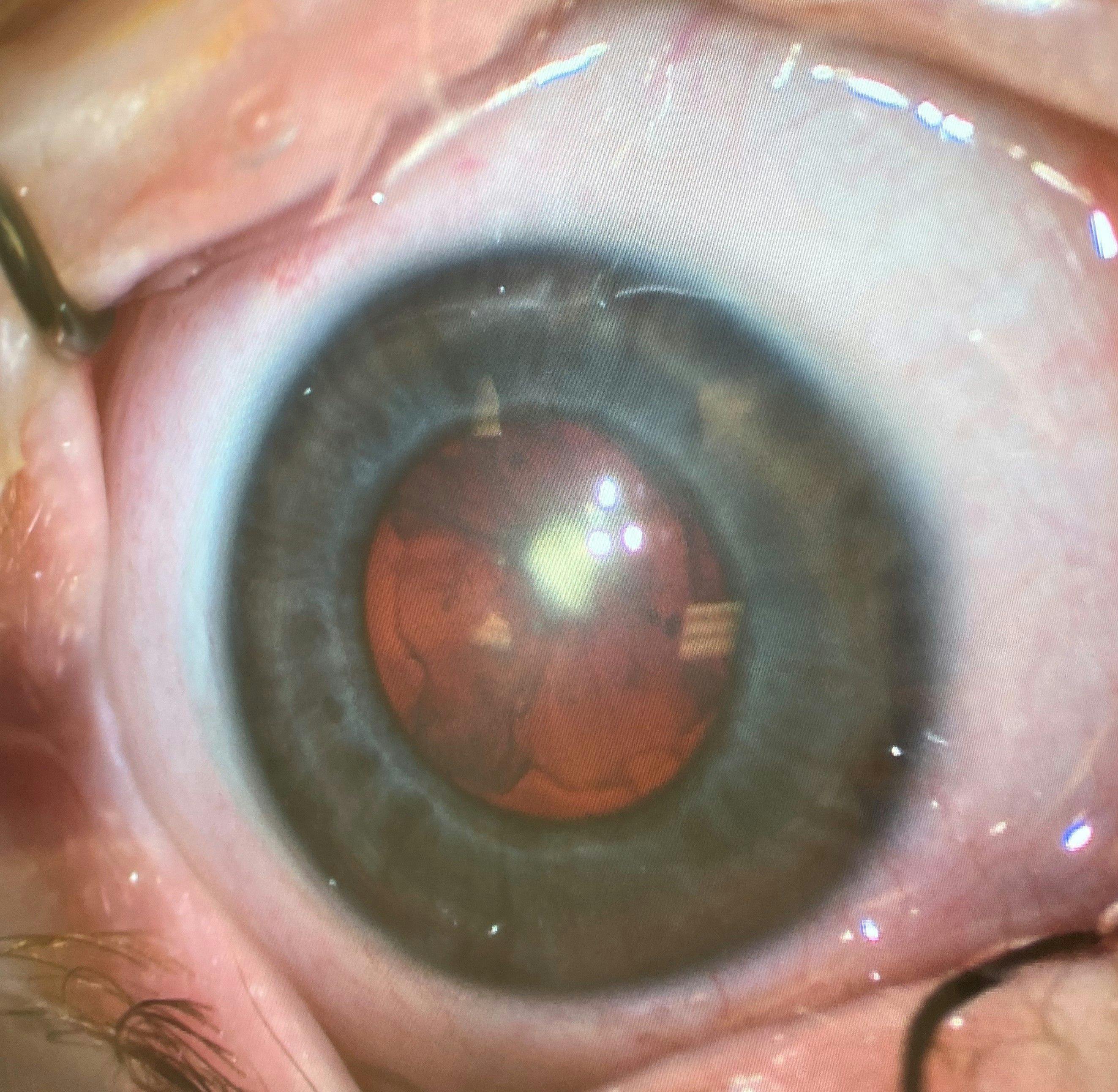 Fetal nuclear cataract