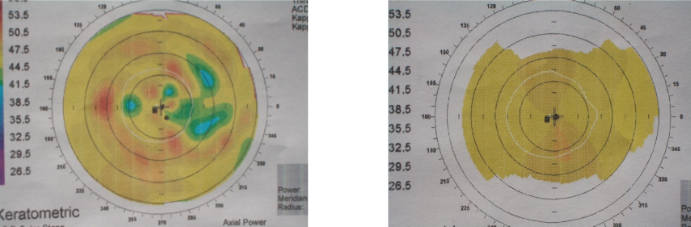 Corneal Topgraphy DED