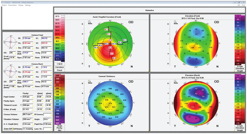 Inferior Corneal Steepening Pentacam