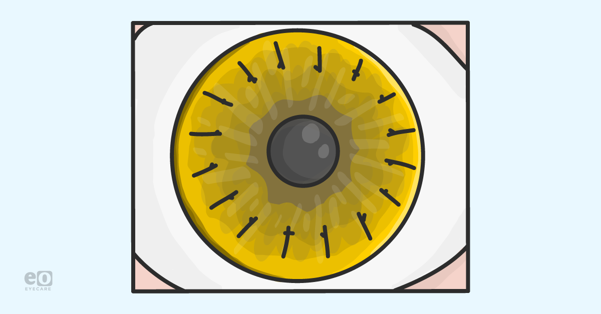 What ODs Should Know About Corneal Transplants