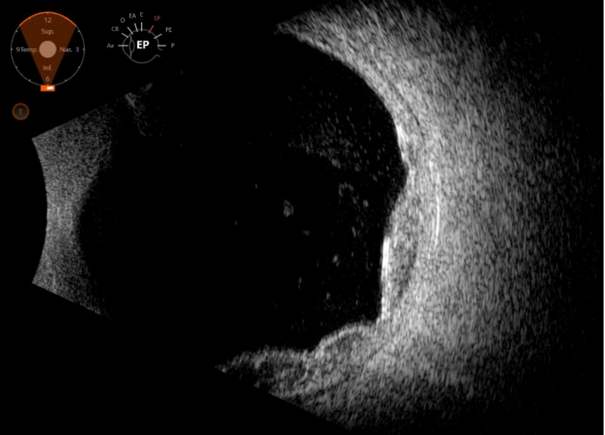 Suprachoroidal Hemorrhage