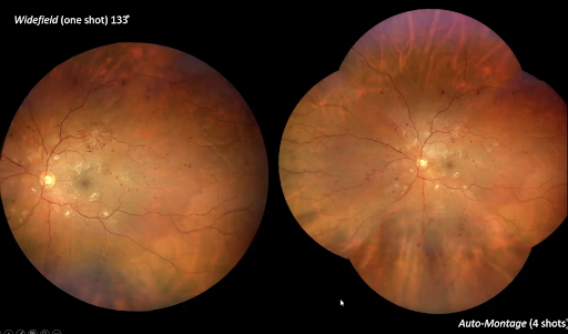 Left Eye Neovascularization