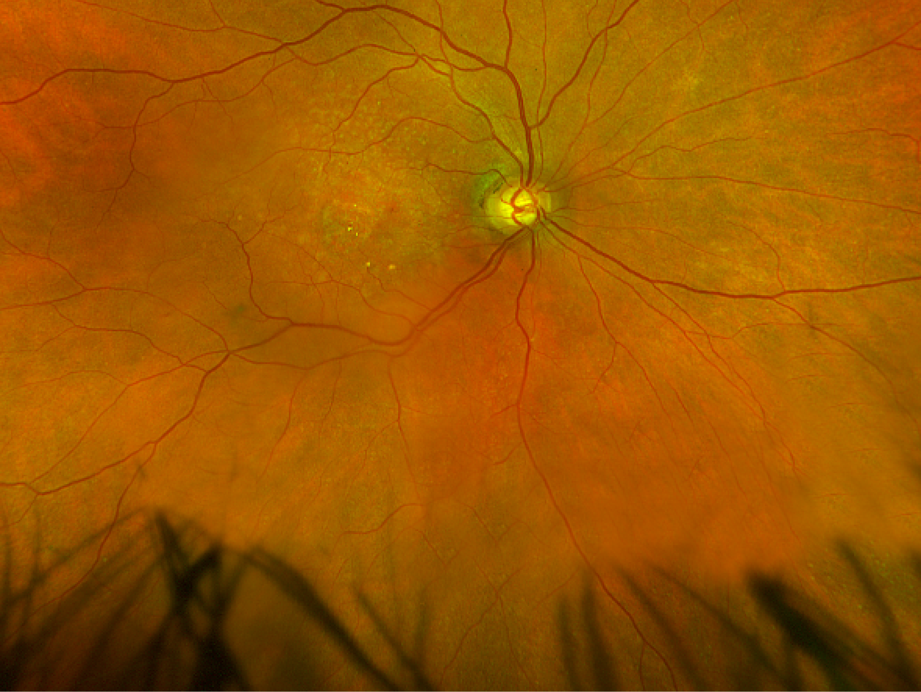 Color Fundus Photo GA