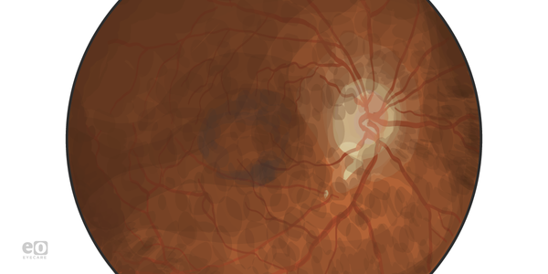 Ophthalmology Case Study: Pentosan Maculopathy Mimicking Pattern Dystrophy