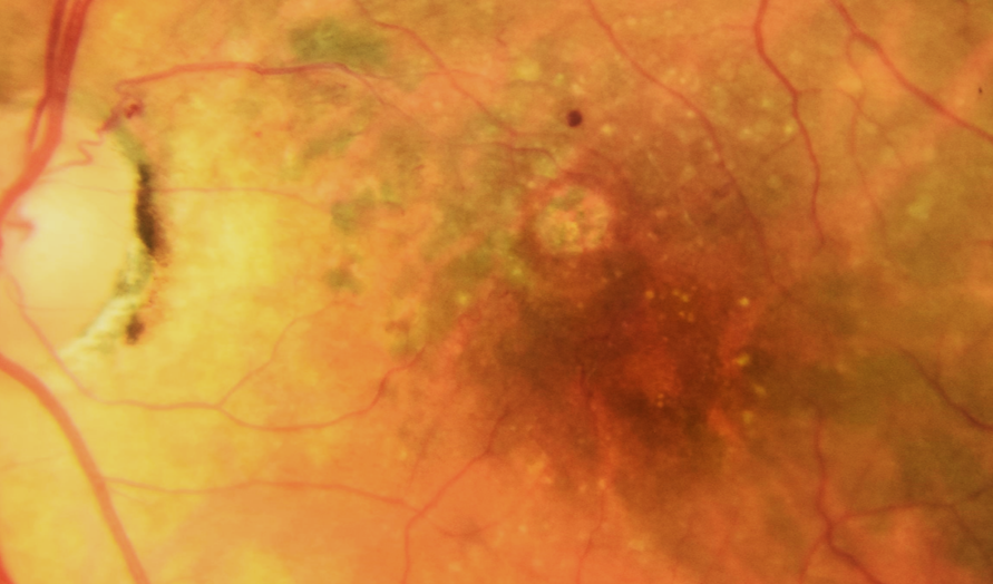 Color fundus photograph GA